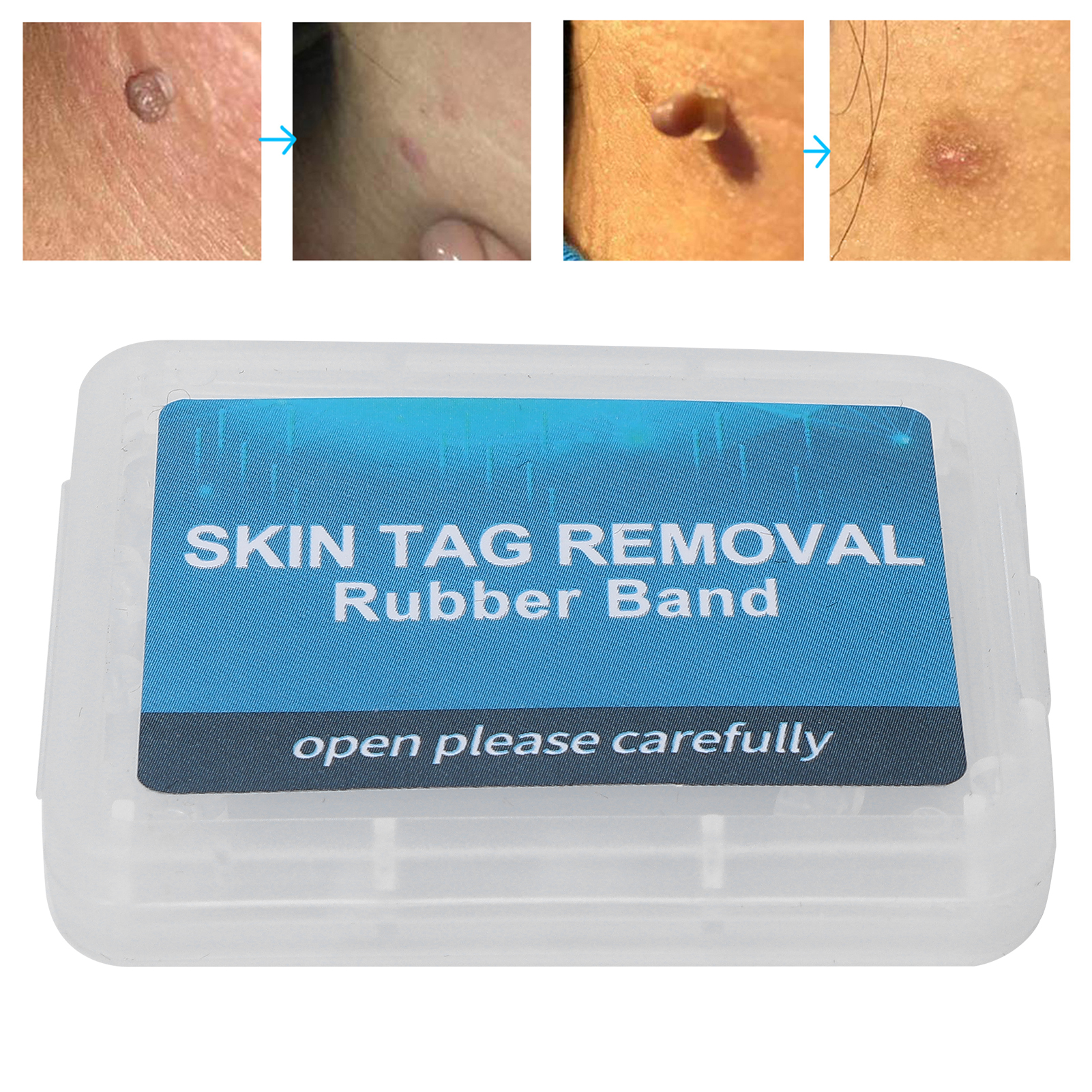 30Pcs Painless Skin Tag Remova - Skincare Ingredients Checker 리뷰 및 가격
