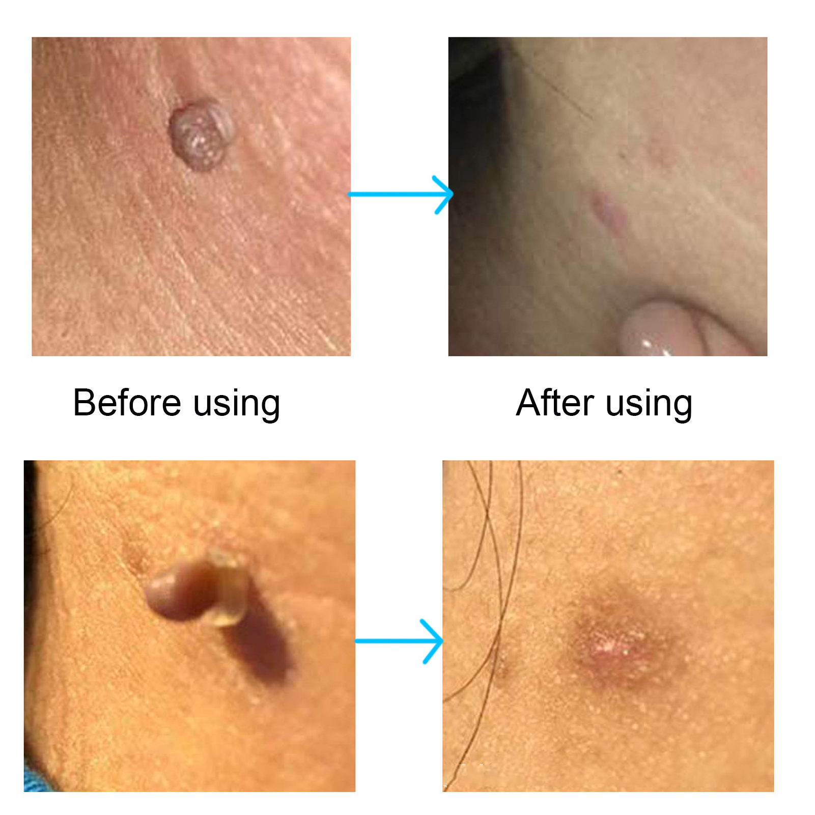 30Pcs Painless Skin Tag Remova - Skincare Ingredients Checker 리뷰 및 가격