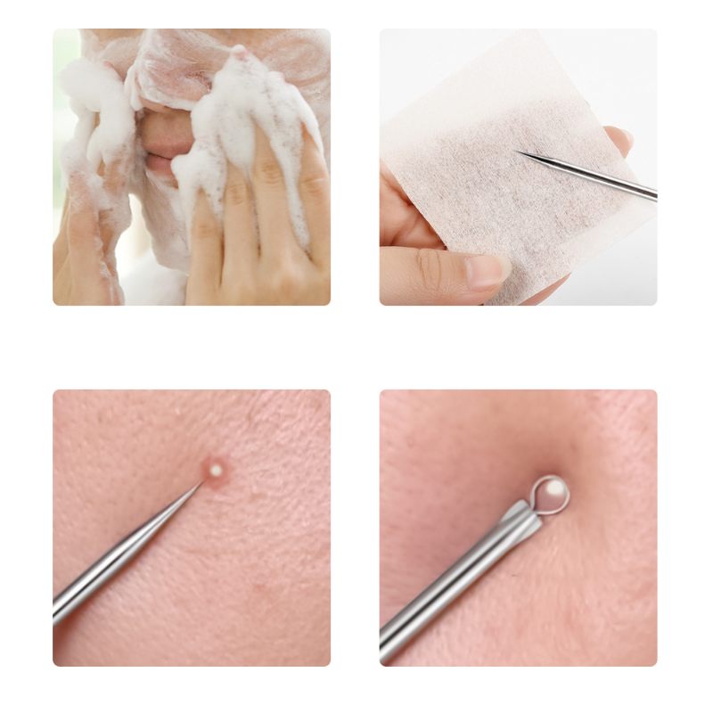 4pcs/set Acne Removal Needles  - Skincare Ingredients Checker 리뷰 및 가격
