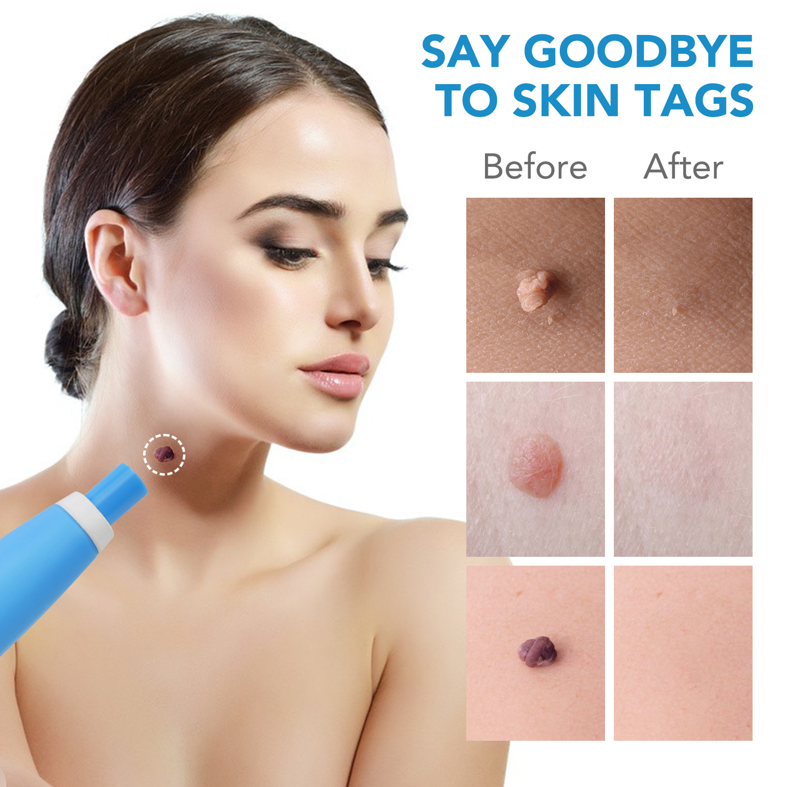2 IN 1 Auto Skin Tag Remover K - Skincare Ingredients Checker 리뷰 및 가격